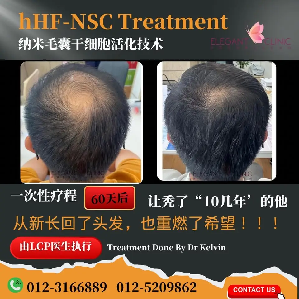 Elegant Clinic Malaysia Static aesthetic clinics ad: Showcase ad for hHF-NSC 治疗