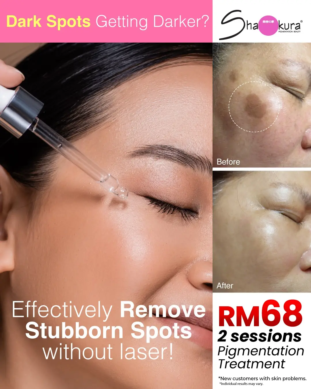 Shakura Dynamic skincare ad: Before-and-after ad for stubborn dark spots faded without laser, RM68 for two sessions
