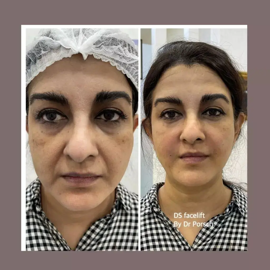 Derma Sculpture Static aesthetic clinics ad: Showcase ad for dS facelift